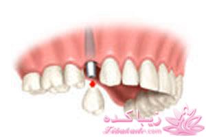 استفاده از ایمپلنت به عنوان جایگزین یک دندان