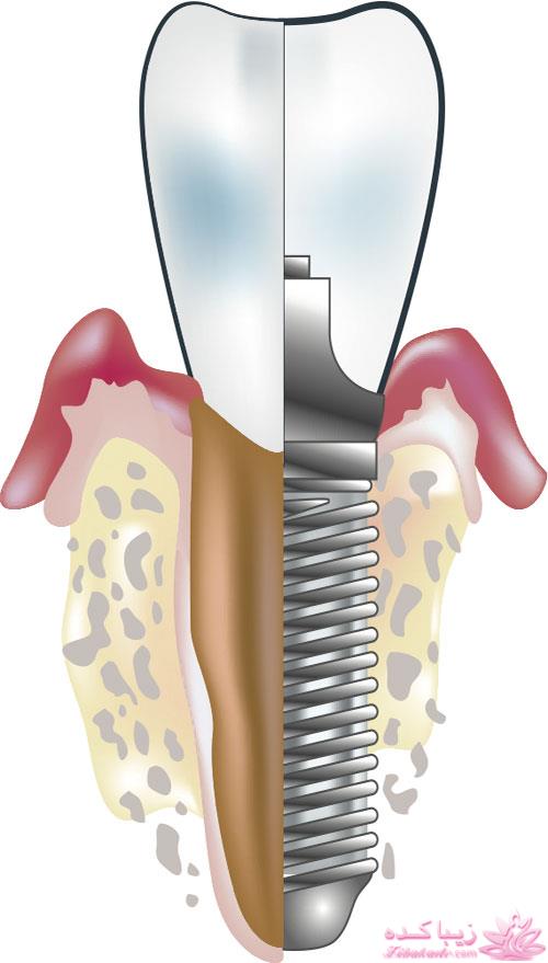 چه افرادی میتوانند ایمپلنت دندان بگذارند؟